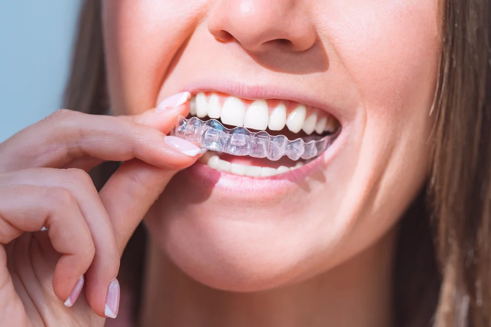 How Does Invisalign Work? Things To Expect During Treatment