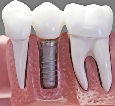 Popular Cosmetic Dentistry Procedures