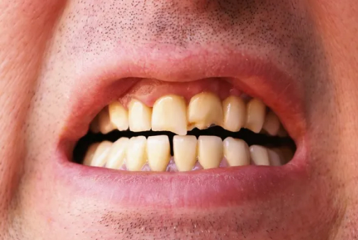 Crack Teeth