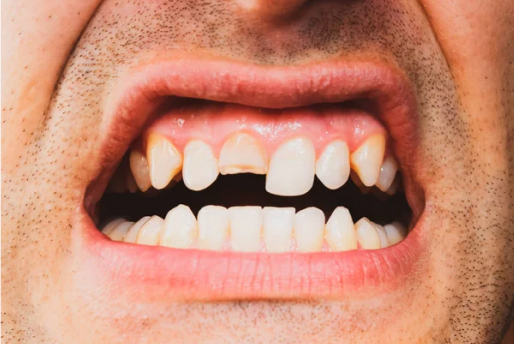 Crack Teeth