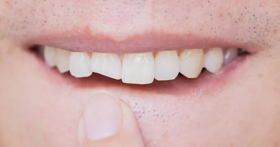Cracked Tooth