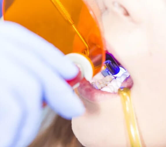 Dental Bonding