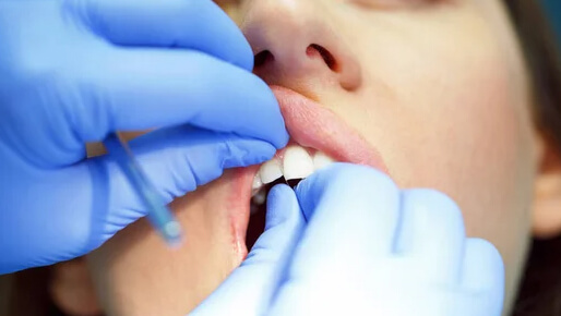 Dental Bonding