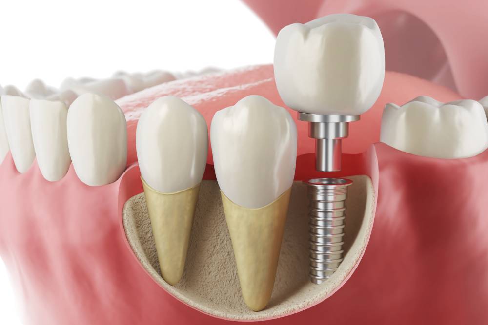 How Much Do Dental Implants Cost In Dublin, CA? A Price Breakdown