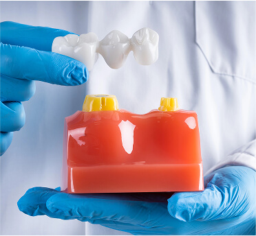Dental Bridges