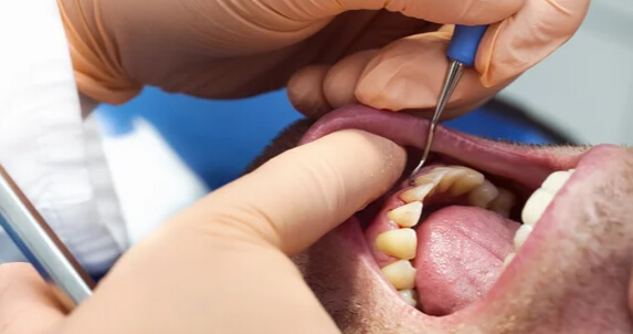 Periodontal Disease