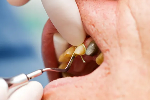 Periodontal Disease