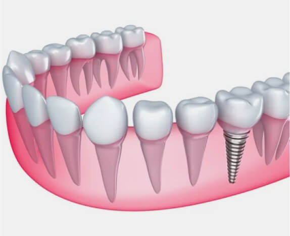 Single tooth implant