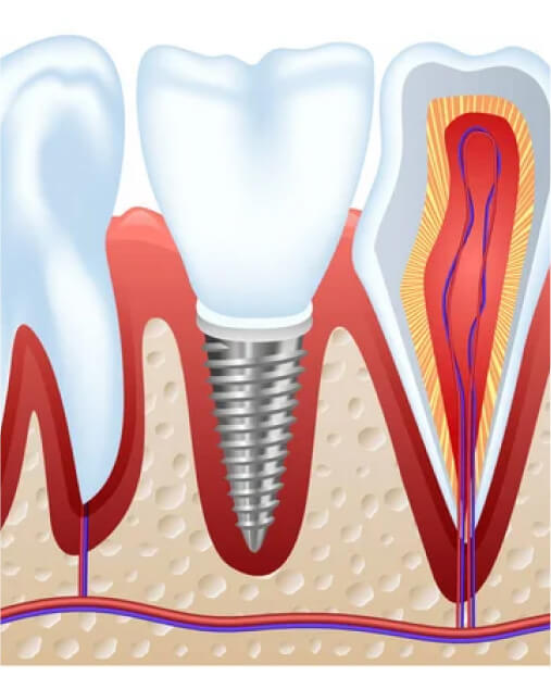Single tooth implant