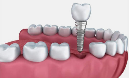 Single tooth implant