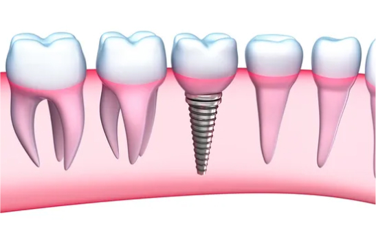 Single tooth implant