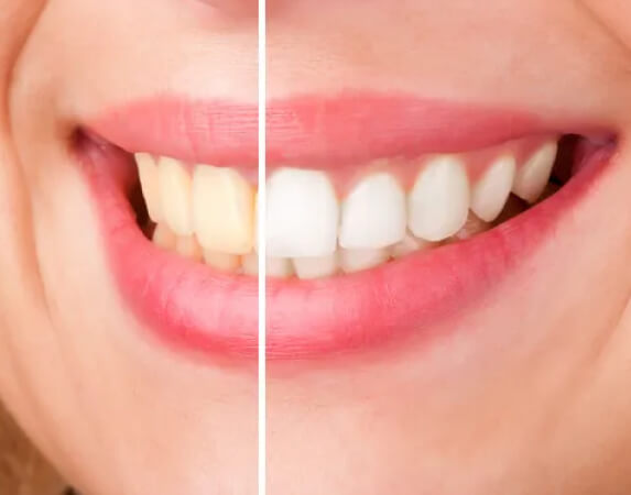 Teeth Whitening