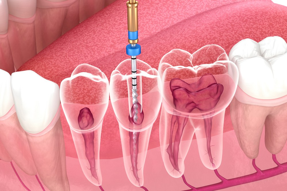 Tooth Extraction Or Root Canal? How To Choose The Right Treatment