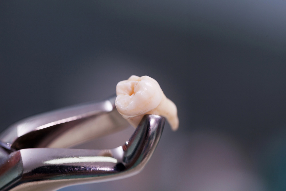 Why Do People Get Their Wisdom Teeth Removed?